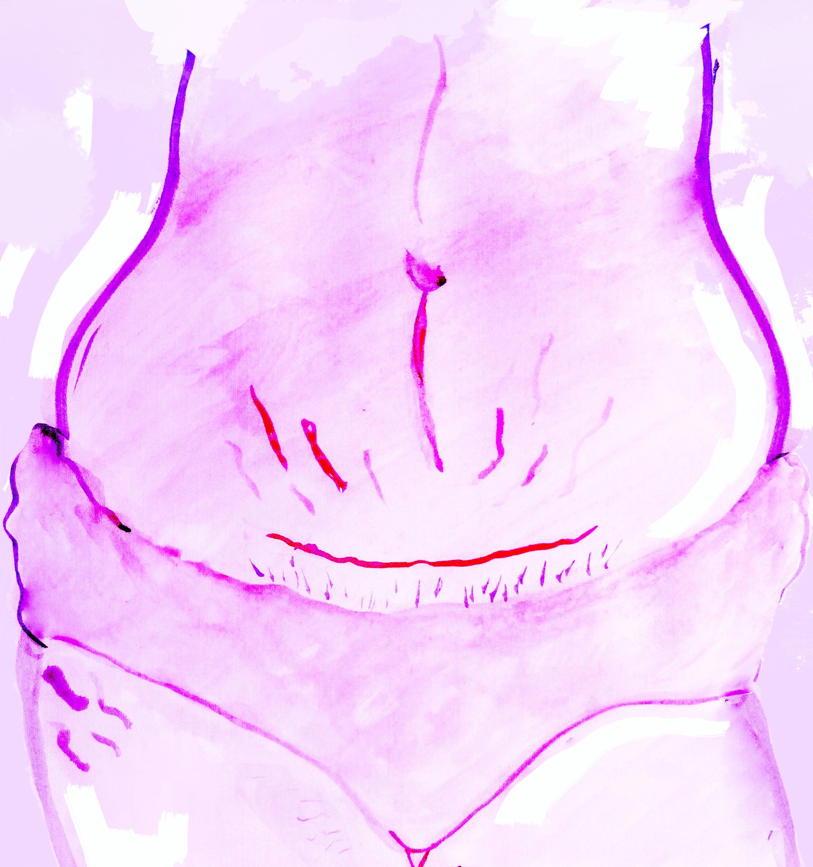 How to Care For a Caesarean Section Scar