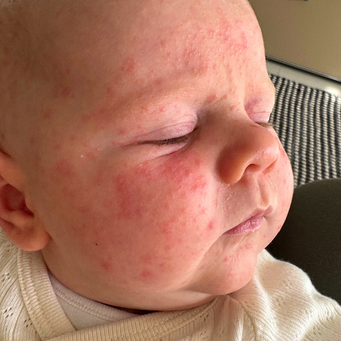 What to Know About Baby Acne